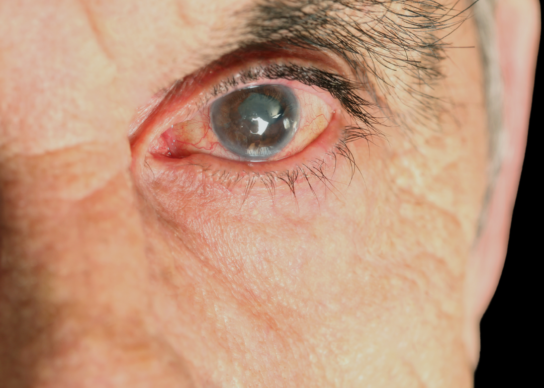 Glaucoma Treatment